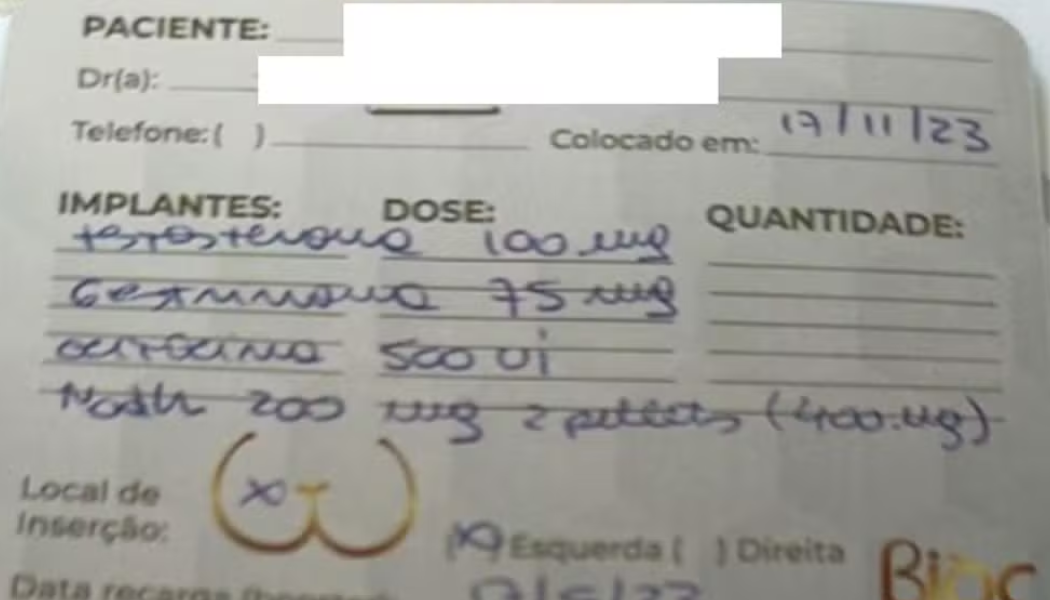Médicos seguem comercializando implantes hormonais após restrição para uso estético, aponta brecha na regulamentação